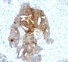 IHC testing of human ovarian carcinoma with TAG-72 antibody.