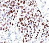 IHC testing of human lung squamous cell carcinoma (SCC) and p21 antibody (WAF21-1) .