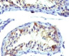 IHC analysis of Prolactin receptor antibody (clone ERSV8-1) and testicular carcinoma.