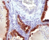 IHC testing of FFPE human lung carcinoma and Cytokeratin 7 antibody