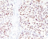 IHC testing of FFPE human melanoma with MITF antibody (clone MPAF3) .