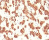 IHC testing of FFPE human thyroid carcinoma and Cytokeratin 18 antibody.