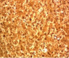 IHC testing of FFPE human hepatocellular carcinoma and Arginase 1 antibody.