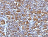 IHC testing of FFPE Hodgkin's Lymphoma with Bax antibody (clone ARBX-1)