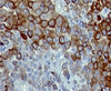 IHC testing of FFPE human melanoma with CD271 antibody.