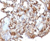 IHC testing of human melanoma and CD146 antibody (clone CDLA146)