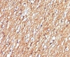 IHC testing of FFPE human brain tumor with CD56 antibody.