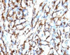 IHC testing of FFPE human angiosarcoma with Smooth Muscle Actin antibody (clone SMAT2-1) .