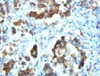 IHC testing of FFPE human gastric carcinoma with Cdc20 antibody (clone CLDC20-1)