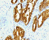 IHC testing of human prostate carcinoma with PSAP antibody (clone PSPN1-1) .