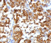 Formalin-fixed, paraffin-embedded human melanoma stained with MART-1 antibody (RMMRT1-1) .