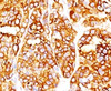 Formalin-fixed, paraffin-embedded human melanoma stained with MART-1 antibody (RMMRT1-1) .