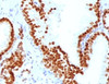 IHC testing of FFPE human prostate carcinoma with FOXA1 antibody.
