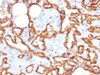 IHC staining of FFPE human angiocarcinoma with recombinant CD31 antibody (clone C31/1395R) . Required HIER: steam sections in pH7.5-8.5, 1mM EDTA for 10-20 min.