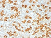 IHC testing of FFPE human Hodgkin's lymphoma stained with recombinant CD30 antibody (clone Ki-1/1505R) . Required HIER: steam sections in pH9, 1mM EDTA for 10-20 min.