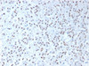 IHC testing of FFPE human mesothelioma tissue with recombinant WT1 antibody (clone WT1/1434R) . HIER: steam sections in 10mM citrate buffer, pH 6.0, for 10-20 min.