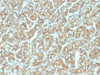 IHC testing of FFPE human thyroid carcinoma and recombinant EpCAM antibody (clone EGP40/1555R) . Required HIER: steam sections in pH6 citrate buffer for 10-20 min.