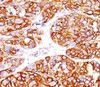 IHC testing of formalin-fixed, paraffin-embedded human melanoma stained with recombinant MART-1 antibody (clone MLANA/1409R) . HIER: steam sections in 10mM citrate buffer, pH 6.0, for 10-20 min.