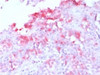 IHC testing of FFPE human melanoma with recombinant Melan-A antibody (clone MLANA/1761R) . HIER: steam sections in 10mM citrate buffer, pH 6.0, for 10-20 min.