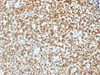 IHC testing of FFPE Ewings sarcoma with recombinant NKX2.2 antibody (clone NX2/1422R) . HIER: steam sections in 10mM citrate buffer, pH 6.0, for 10-20 min.