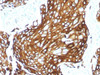 IHC staining of FFPE human lung carcinoma with recombinant Acidic Cytokeratin. HIER: boil tissue sections in pH6, 10mM citrate buffer, for 10-20 min and allow to cool before testing.