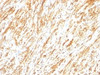 Formalin-fixed, paraffin-embedded human schwanoma stained with Glial Fibrillary Acidic Protein antibody (SPM248) .