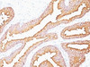 Formalin-fixed, paraffin-embedded human prostate carcinoma stained with PSA antibody (SPM352) .