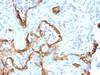 Formalin-fixed, paraffin-embedded human lung carcinoma stained with Cytokeratin 8 antibody (SPM192) .