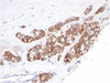 Formalin-fixed, paraffin-embedded human breast carcinoma stained with anti-Cytokeratin 18 antibody (SPM510) .