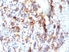 Formalin-fixed, paraffin-embedded human gastric carcinoma stained with Mucin-5AC antibody (SPM297) .