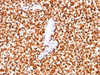 Formalin-fixed paraffin-embedded human Ewing's sarcoma stained with NKX2.2 antibody (SPM564) .