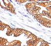 Formalin-fixed, paraffin-embedded human prostate carcinoma stained with ODC-1 antibody (SPM565)