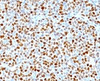 Formalin-fixed, paraffin-embedded human mantle cell lymphoma stained with CCND1 antibody.