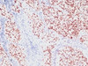 Formalin-fixed, paraffin-embedded human lung carcinoma stained with NKX2.1 antibody (SPM150)