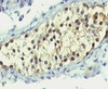 Formalin-fixed, paraffin-embedded human testicular carcinoma stained with anti-Thymidylate Synthase antibody (SPM453) .