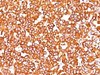 Formalin-fixed, paraffin-embedded human melanoma stained with VIM antibody (SPM576) .