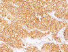 Formalin-fixed, paraffin-embedded human renal cell carcinoma stained with CA9 antibody (SPM314) .