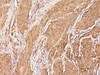 Formalin-fixed, paraffin-embedded human Leiomyosarcoma stained with Muscle Specific Actin antibody (SPM160)