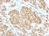 Formalin-fixed, paraffin-embedded human melanoma stained with Melan-A antibody (SPM555) .