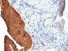 Formalin-fixed, paraffin-embedded human bladder carcinoma stained with Cytokeratin 19 antibody (SPM561)