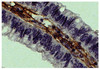 Human gastric cancer tissue was stained with Goat Anti-Type III Collagen-UNLB (Cat. No. 98-505) followed by Swine Anti-Goat IgG (H+L) , Human/Rat/Mouse SP ads-HRP .