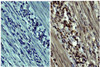 Human gastric cancer tissue was stained with Mouse IgG2a-HRP (Isotype Control; Cat. No. 0103-05) or Mouse Anti-Human MMP-9-HRP (Cat. No. 99-774) .