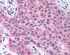 Immunohistochemistry staining of MMP13 in breast carcinoma tissue using MMP13 Antibody.