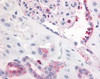 Immunohistochemistry staining of PDGFRB in kidney, glomerulus and renal tubular epithelium in cortex tissue using PDGFRB Antibody.