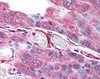 Immunohistochemistry staining of PLA2G3 in colon carcinoma tissue using PLA2G3 Antibody.