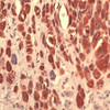 Immunohistochemistry staining of S100A4 in melanoma tissue using S100A4 Antibody.