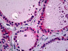 Immunohistochemistry of human thyroid tissue stained using SP-D Monoclonal Antibody.