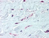 Immunohistochemistry staining of PDGFRA in breast, fibroblasts tissue using PDGFRA Antibody.
