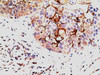 45-548 (5ug/ml) staining of paraffin embedded Human Breast Carcinoma. Steamed antigen retrieval with citrate buffer pH 6, AP-staining.