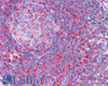 45-454 (0.1ug/ml) staining of Human Breast cancer lysate (35ug protein in RIPA buffer) . Primary incubation was 1 hour. Detected by chemiluminescence.